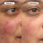 Balsamo al Calcio per Psoriasi e Eczema