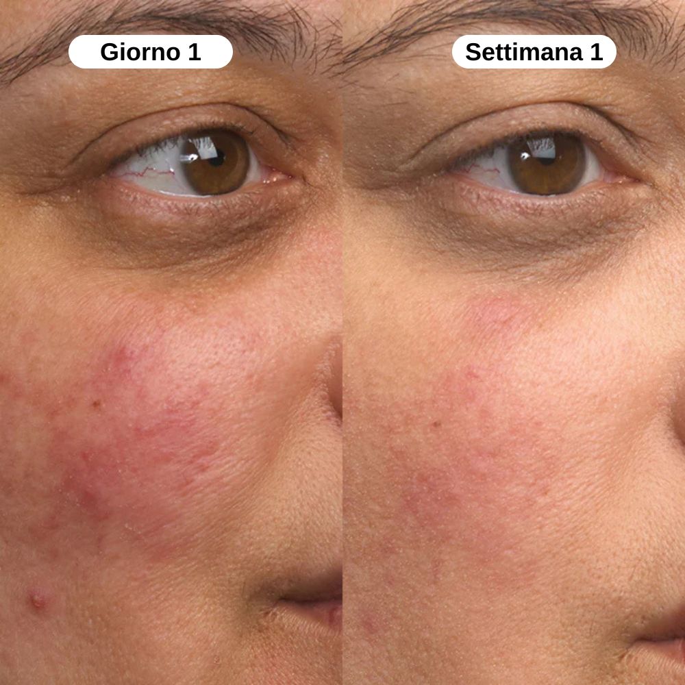 Balsamo al Calcio per Psoriasi e Eczema
