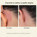 Balsamo al Calcio per Psoriasi e Eczema