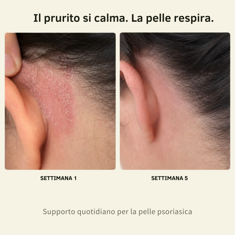 Balsamo al Calcio per Psoriasi e Eczema