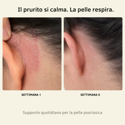Balsamo al Calcio per Psoriasi e Eczema